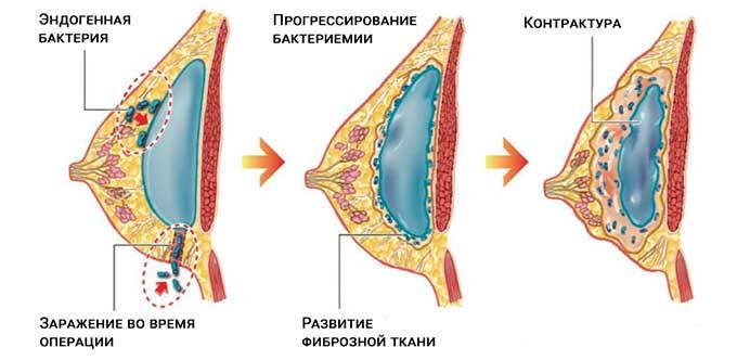 Капсулярная контрактура после маммопластики молочной железы: признаки и симптомы